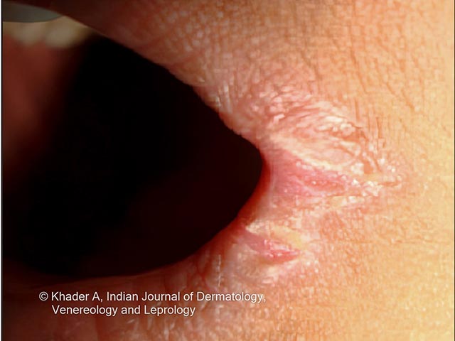 Angular cheilitis seen in PLACK syndrome (courtesy of Dr AS Vidya, Kerala, India)