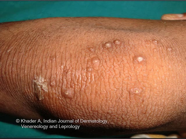 Hyperkeratotic papules on the extensor aspect of the knee in PLACK syndrome