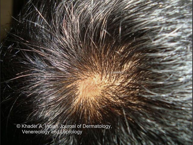 A patch of alopecia areata - an unusual association with PLACK syndrome (courtesy of Dr AS Vidya, Kerala, India)