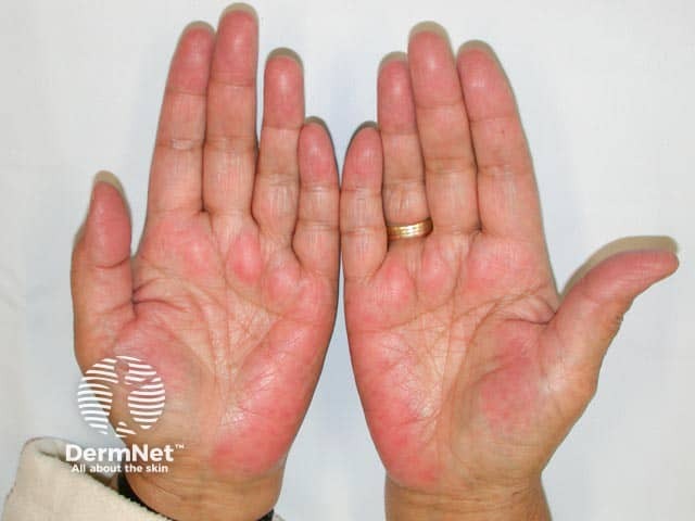 Palmar erythema