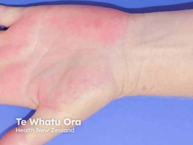 Palmar erythema