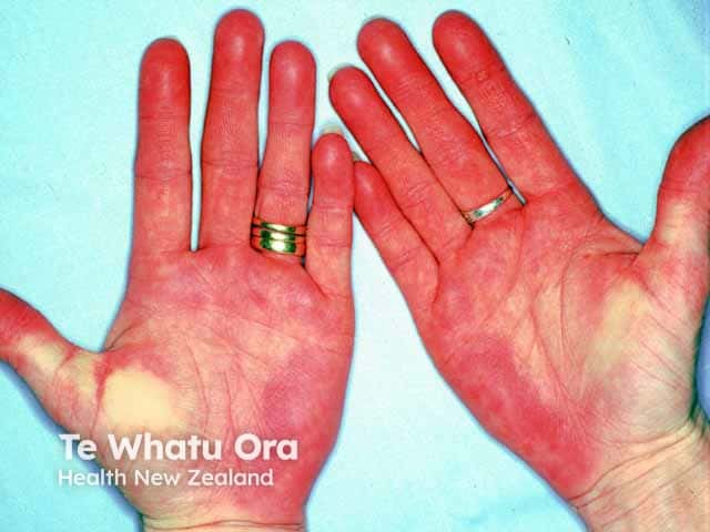 Marked palmar erythema