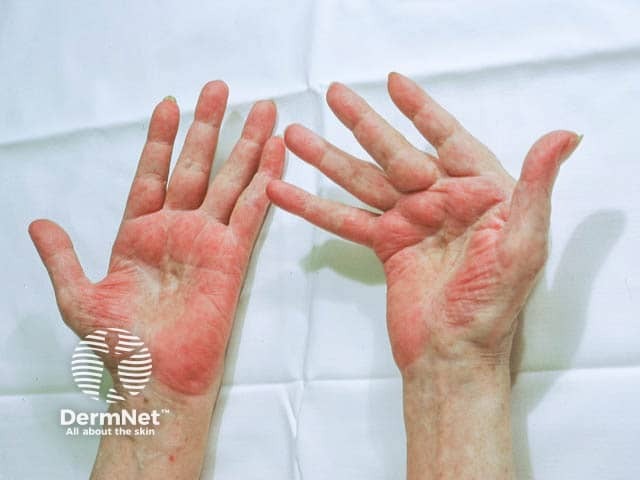 Palmar erythema in rheumatoid arthritis