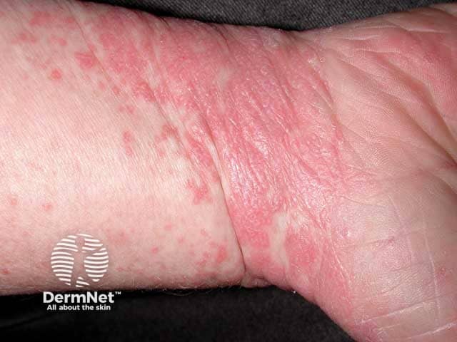 Papular lichen planus coalescing into plaques on the wrist