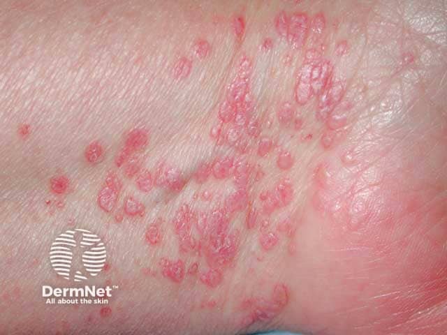 Flat topped, shiny, polygonal papules of lichen planus on the volar wrist