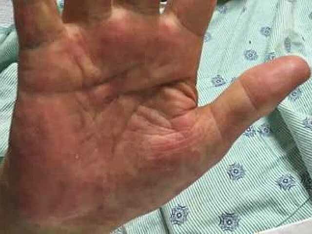 Papular purpuric gloves and socks syndrome: EBV