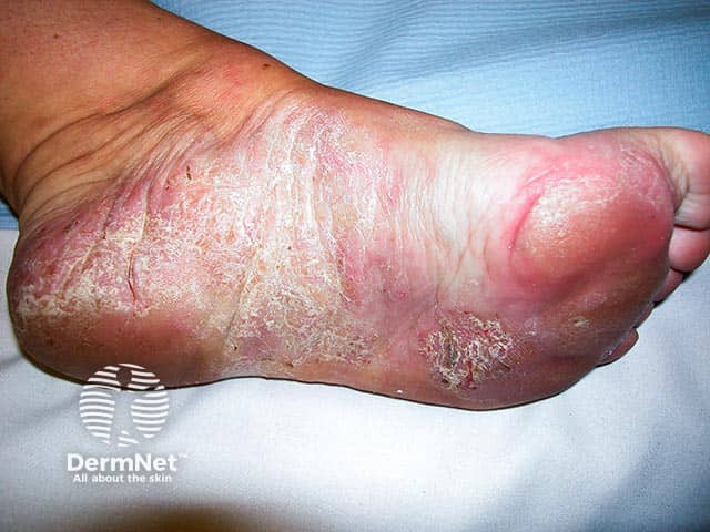 Psoriasiform eruption that arose 7 months after initiation of adalimumab for inflammatory bowel disease