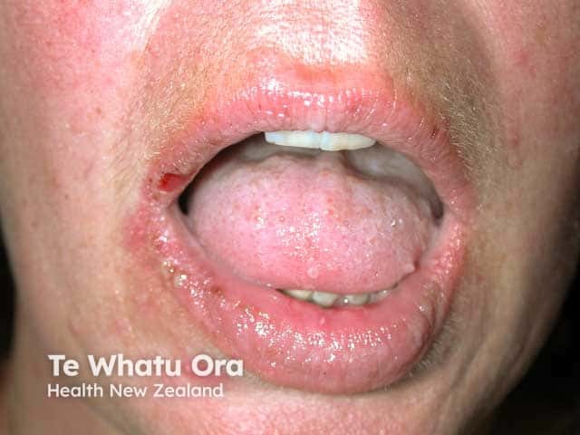 Oral and lip erosions in paraneoplastic pemphigus