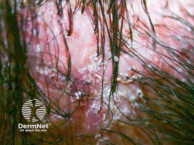 Scarring and tufting of the scalp due to paraneoplastic pemphigus