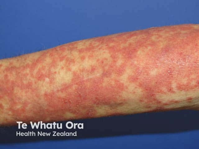 Paraneoplastic pemphigus on the arm