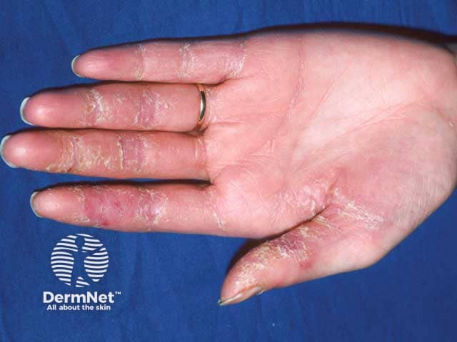 Palmar changes in paraneoplastic pemphigus associated with Castleman disease