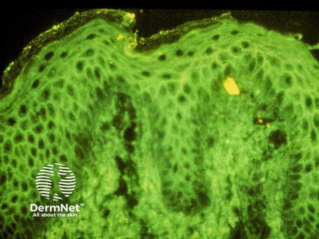 Direct immunofluorescence of perilesional skin in pemphigus vulgaris - immunostaining with IgG producing intercellular 