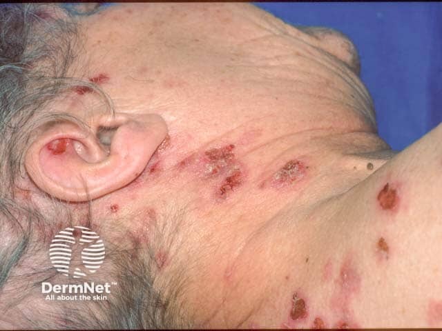 Erosions over the neck and upper back in pemphigus vulgaris