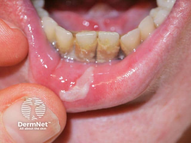 Chronic lip erosion in pemphigus vulgaris