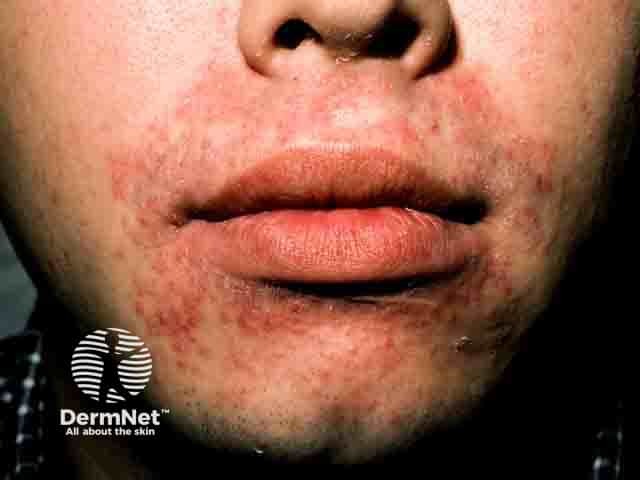 Perioral papules typical of perioral dermatitis