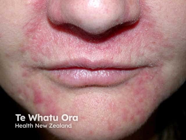 Nasolabial and perioral papules in perioral dermatitis