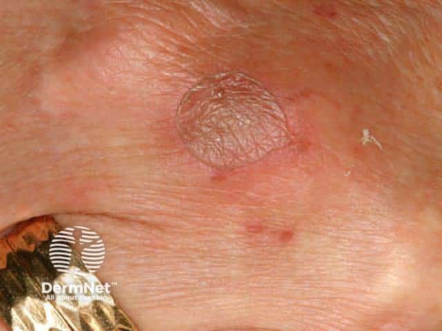 Bullous phytophotodermatitis