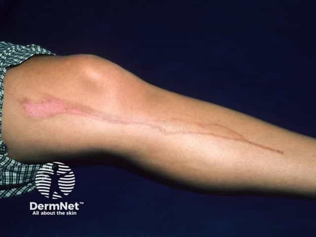 Phytophotodermatitis from sun bed use after lime juice spillage onto skin