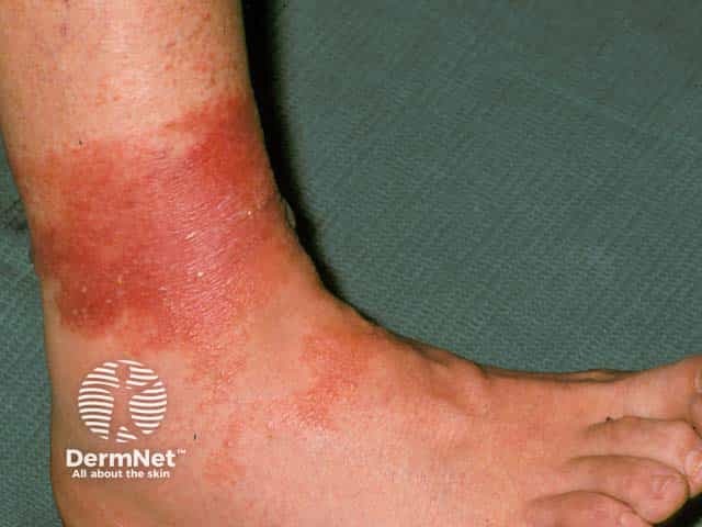 Phytophotodermatitis