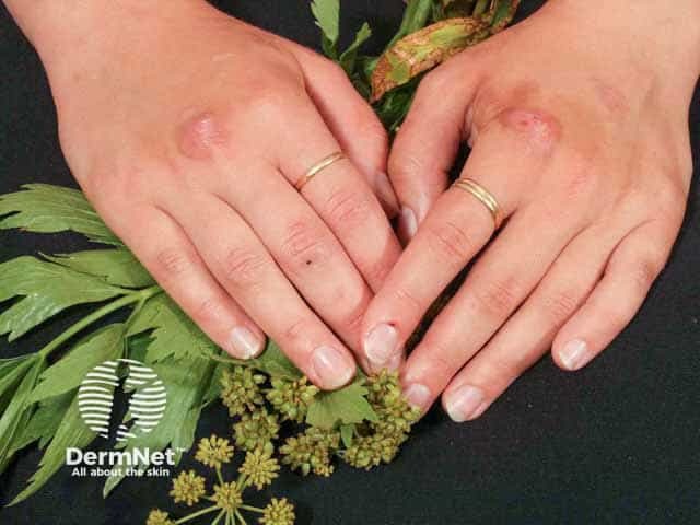 Phytophotodermatitis and the suspect plant