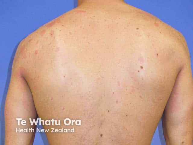 Phytophotodermatitis