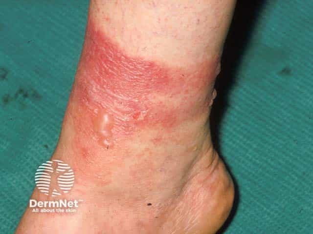 Acute bullous phytophotodermatitis on the ankle