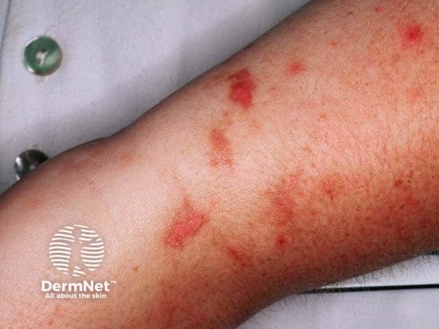 Streaky erythema on the arm