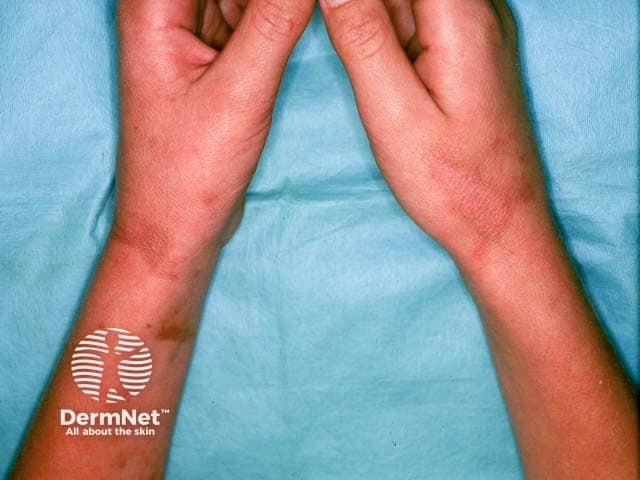 Post inflammatroy pigmentation after phytophotodermatitis