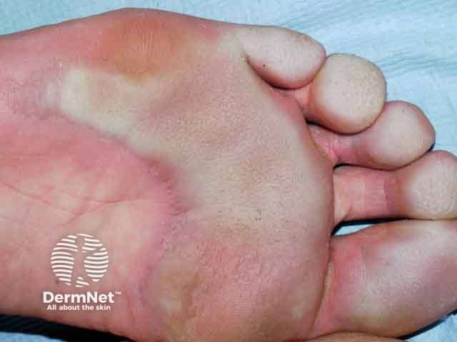 Pits and maceration on the sole and toes in pitted keratolysis