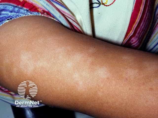 Pityriasis alba on the upper arm