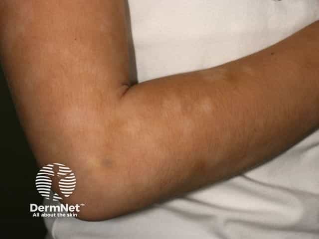 Pityriasis alba on the arms