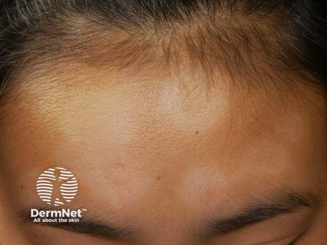 Forehead pityriasis alba