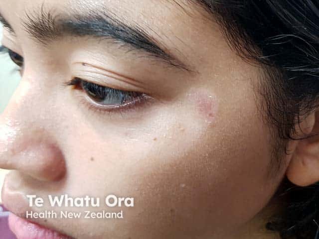 Mild eczema, scale and hypopigmentation in pityriasis alba