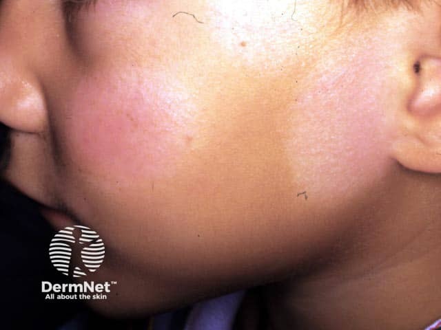 Pityriasis alba on the cheeks