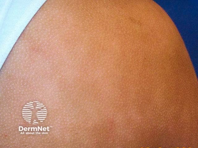 Follicular eczema and hypopigmentation in pityriasis alba on the shoulder