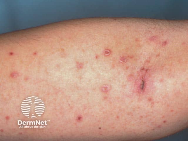 Pityriasis lichenoides acuta on the arm