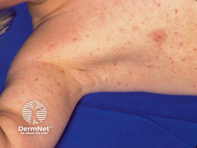 Pityriasis lichenoides chronica on the chest and upper arm