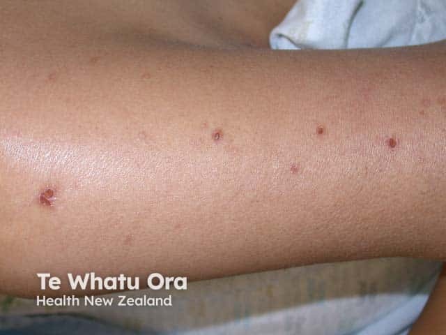 Pityriasis lichenoides chronica on the upper arm