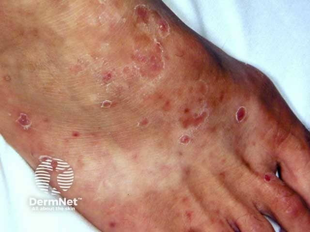 Pityriasis lichenoides acuta on the foot