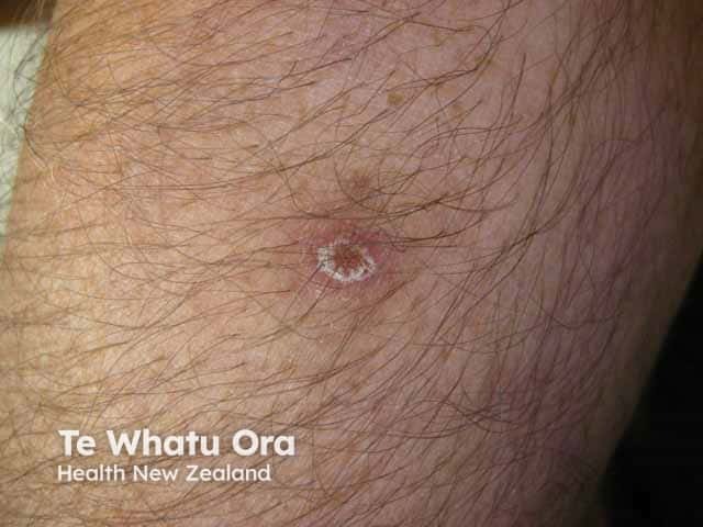 An acute inflammatory papule in pityriasis lichenoides acuta