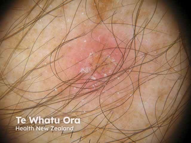 Pityriasis lichenoides acuta on dermoscopy