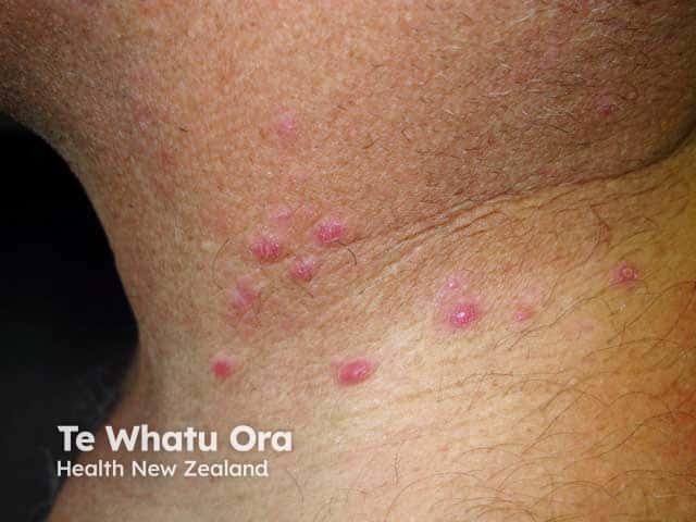 Pityriasis lichenoides acuta on the neck