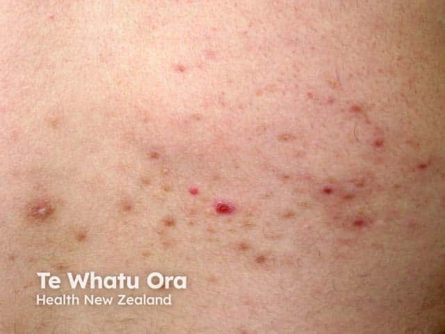 Scattered papules of pityriasis lichenoides acuta on the back