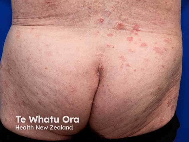 Pityriasis lichenoides chronica on the lower back