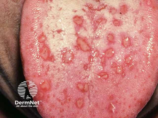 Lingual ulcers in pityriasis lichenoides acuta