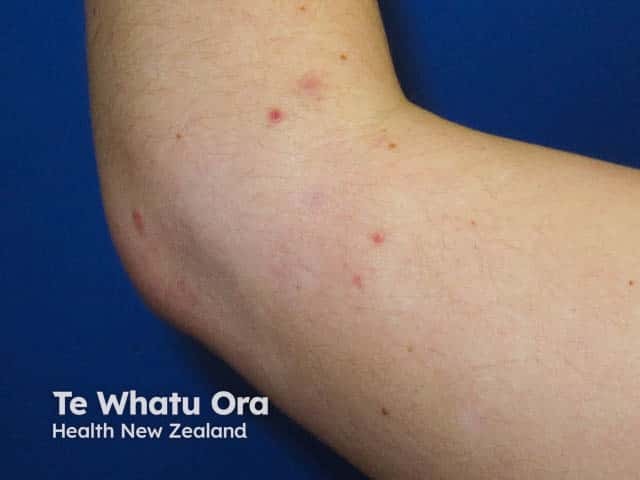 Pityriasis lichenoides acuta on the elbow