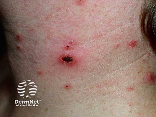 Ulcerated papules in pityriasis lichenoides acuta