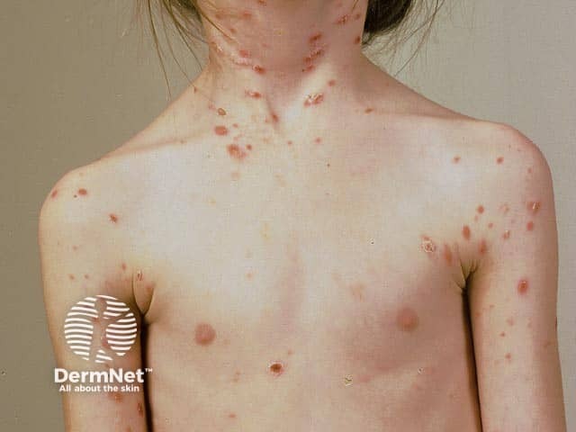 Pityriasis lichenoides acuta in a child