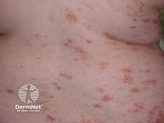 Purpuric pityriasis rosea