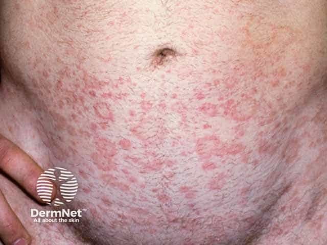 Pityriasis rosea on the abdomen